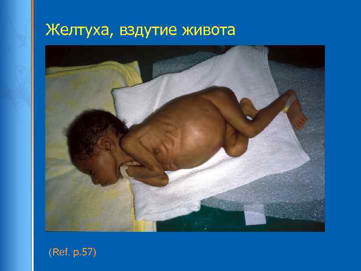 Желтуха, вздутие живота (Ref. p. 57) 