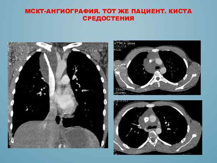 МСКТ-АНГИОГРАФИЯ. ТОТ ЖЕ ПАЦИЕНТ. КИСТА СРЕДОСТЕНИЯ 