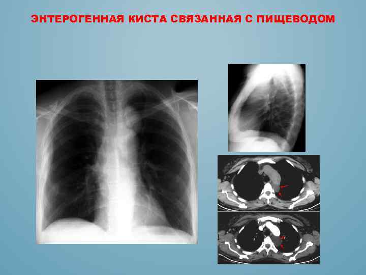 Кисты средостения презентация