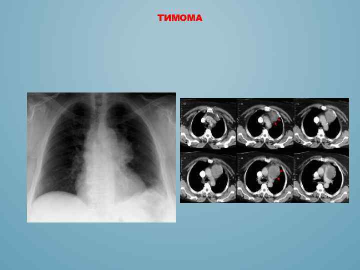 Тимома степени НП снимках. Примеры диагноза тимома.