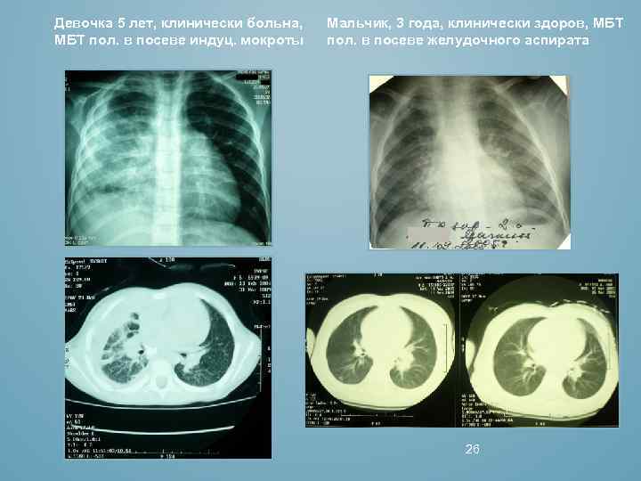 Девочка 5 лет, клинически больна, МБТ пол. в посеве индуц. мокроты Мальчик, 3 года,