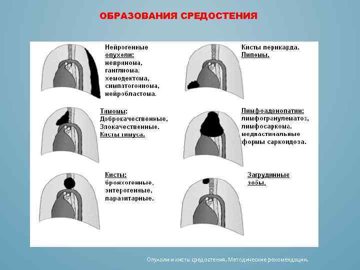 ОБРАЗОВАНИЯ СРЕДОСТЕНИЯ Опухоли и кисты средостения. Методические рекомендации. 