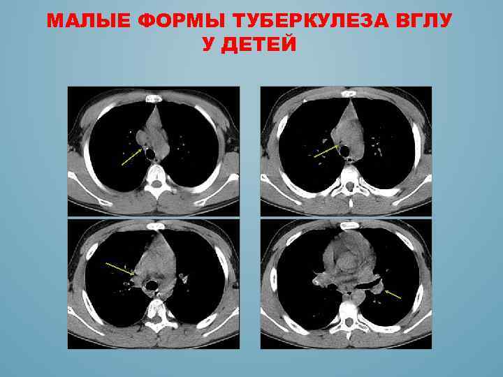 МАЛЫЕ ФОРМЫ ТУБЕРКУЛЕЗА ВГЛУ У ДЕТЕЙ 