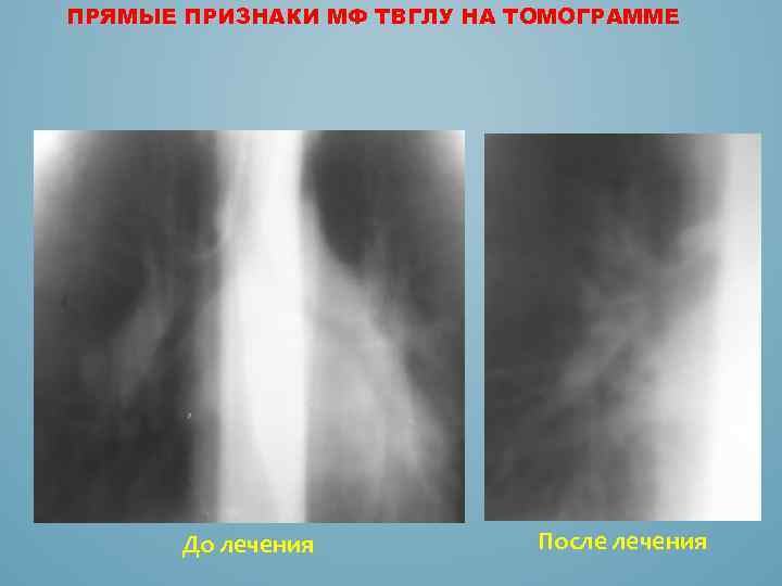 ПРЯМЫЕ ПРИЗНАКИ МФ ТВГЛУ НА ТОМОГРАММЕ До лечения После лечения 