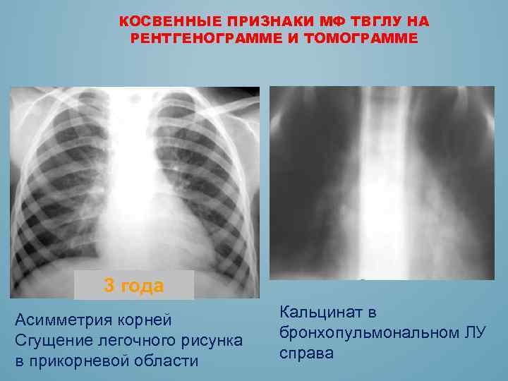 КОСВЕННЫЕ ПРИЗНАКИ МФ ТВГЛУ НА РЕНТГЕНОГРАММЕ И ТОМОГРАММЕ 3 года Асимметрия корней Сгущение легочного