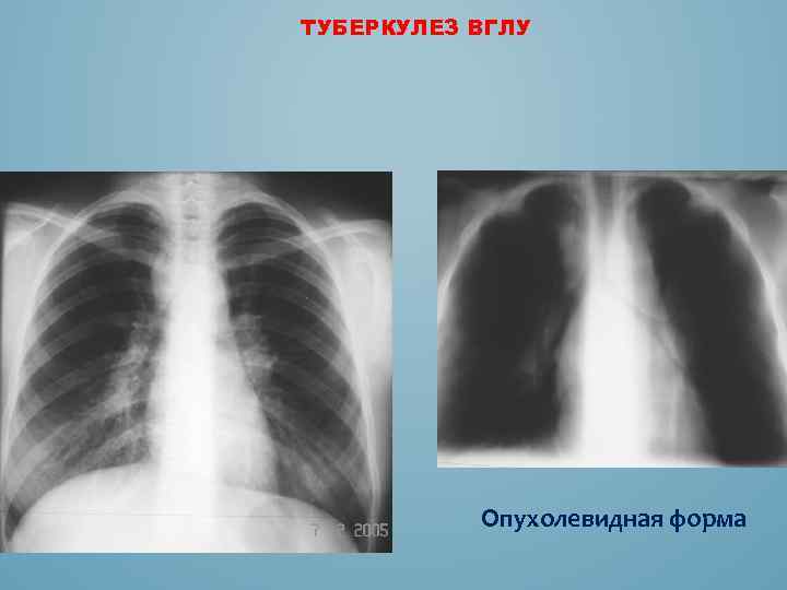 ТУБЕРКУЛЕЗ ВГЛУ Опухолевидная форма 