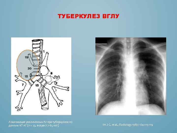 ТУБЕРКУЛЕЗ ВГЛУ Локализация увеличенных ЛУ при туберкулезе по данным КТ АГ (n = 23,