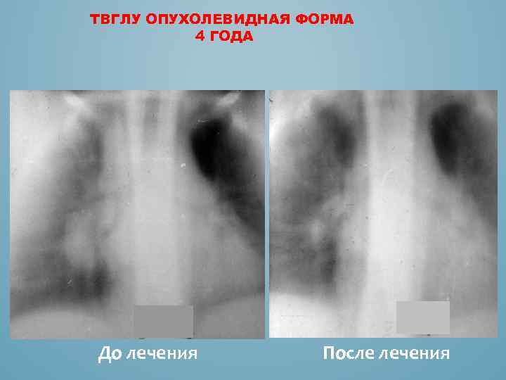 ТВГЛУ ОПУХОЛЕВИДНАЯ ФОРМА 4 ГОДА До лечения После лечения 