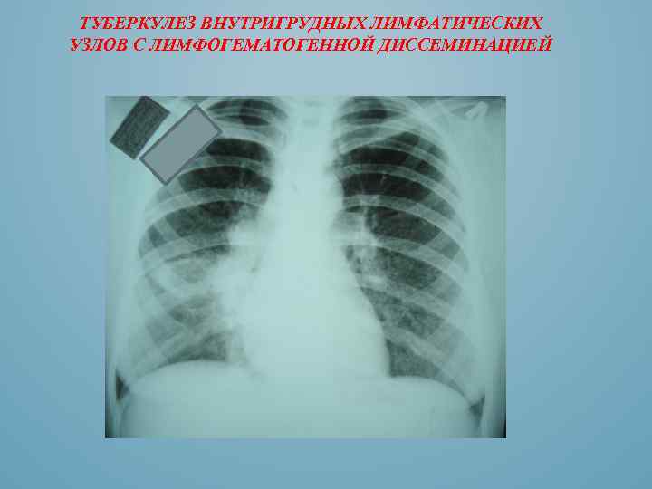 ТУБЕРКУЛЕЗ ВНУТРИГРУДНЫХ ЛИМФАТИЧЕСКИХ УЗЛОВ С ЛИМФОГЕМАТОГЕННОЙ ДИССЕМИНАЦИЕЙ 