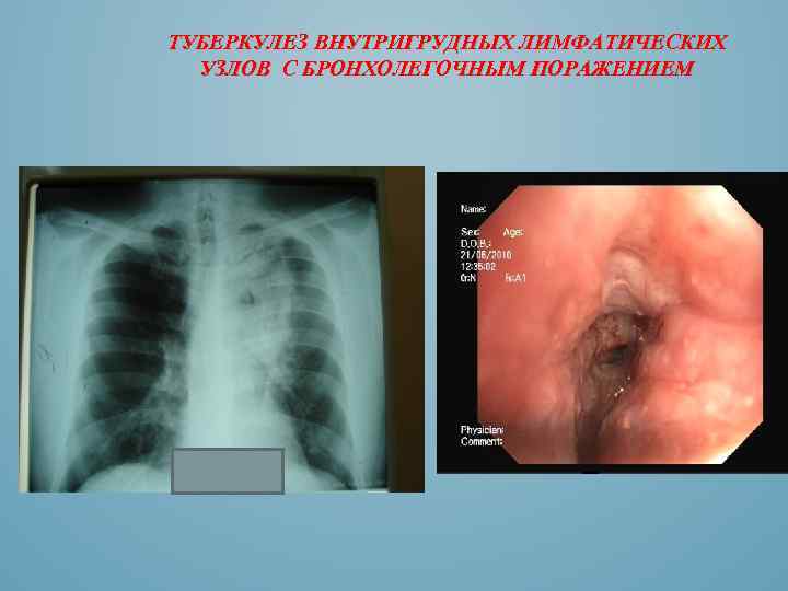 ТУБЕРКУЛЕЗ ВНУТРИГРУДНЫХ ЛИМФАТИЧЕСКИХ УЗЛОВ С БРОНХОЛЕГОЧНЫМ ПОРАЖЕНИЕМ 