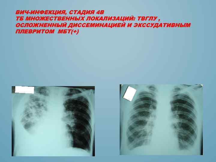 ВИЧ-ИНФЕКЦИЯ, СТАДИЯ 4 В ТБ МНОЖЕСТВЕННЫХ ЛОКАЛИЗАЦИЙ: ТВГЛУ , ОСЛОЖНЕННЫЙ ДИССЕМИНАЦИЕЙ И ЭКССУДАТИВНЫМ ПЛЕВРИТОМ