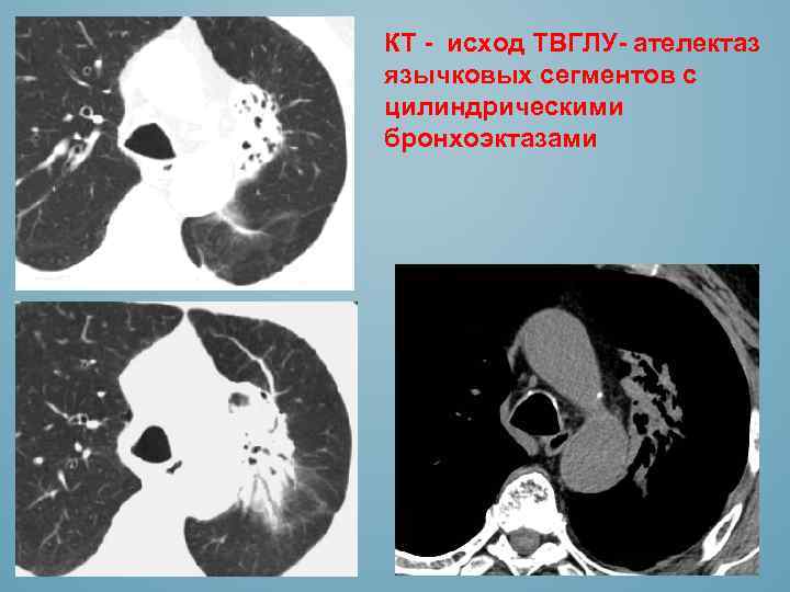 КТ - исход ТВГЛУ- ателектаз язычковых сегментов с цилиндрическими бронхоэктазами 