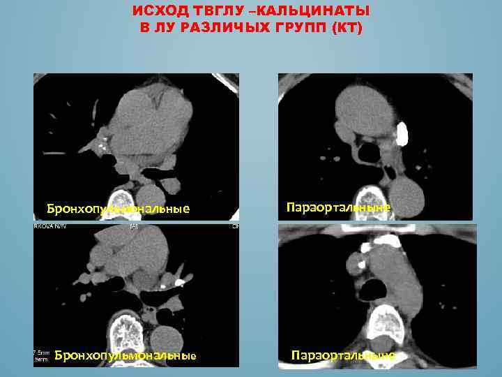 ИСХОД ТВГЛУ –КАЛЬЦИНАТЫ В ЛУ РАЗЛИЧЫХ ГРУПП (КТ) Бронхопульмональные Параортальныне 
