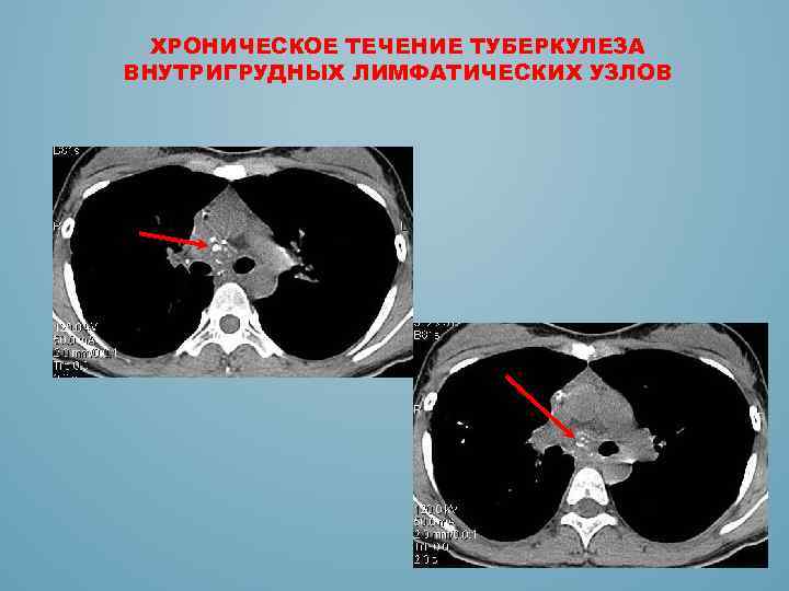 ХРОНИЧЕСКОЕ ТЕЧЕНИЕ ТУБЕРКУЛЕЗА ВНУТРИГРУДНЫХ ЛИМФАТИЧЕСКИХ УЗЛОВ 