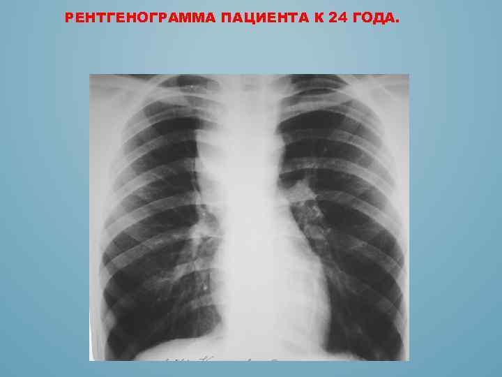 РЕНТГЕНОГРАММА ПАЦИЕНТА К 24 ГОДА. 