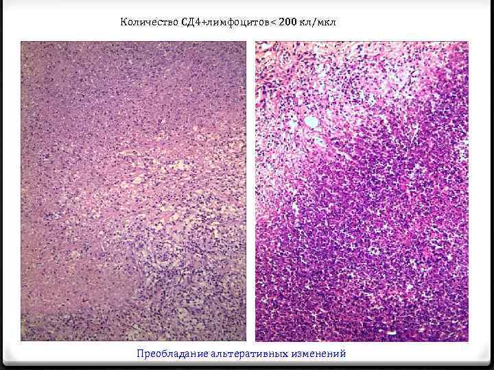 Количество СД 4+лимфоцитов< 200 кл/мкл Преобладание альтеративных изменений 