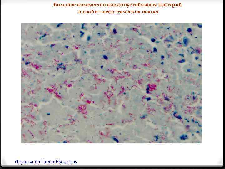 Большое количество кислотоустойчивых бактерий в гнойно-некротических очагах Окраска по Цилю-Нильсену 