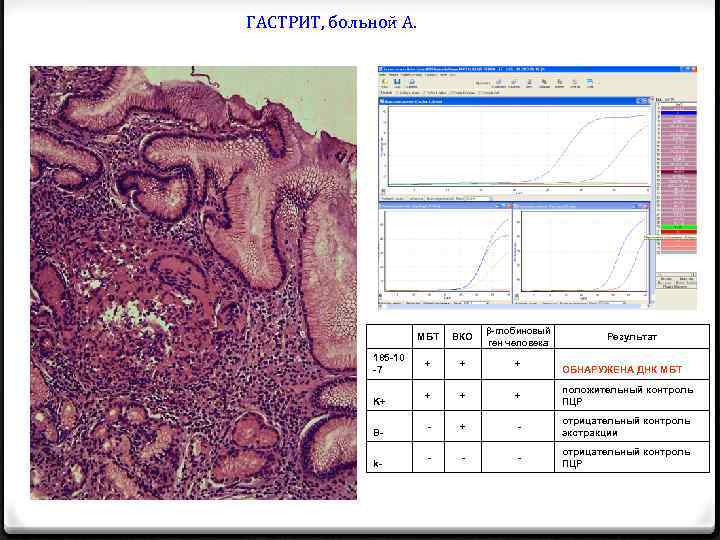 ГАСТРИТ, больной А. МБТ 185 -10 -7 K+ Bk- ВКО β-глобиновый ген человека +