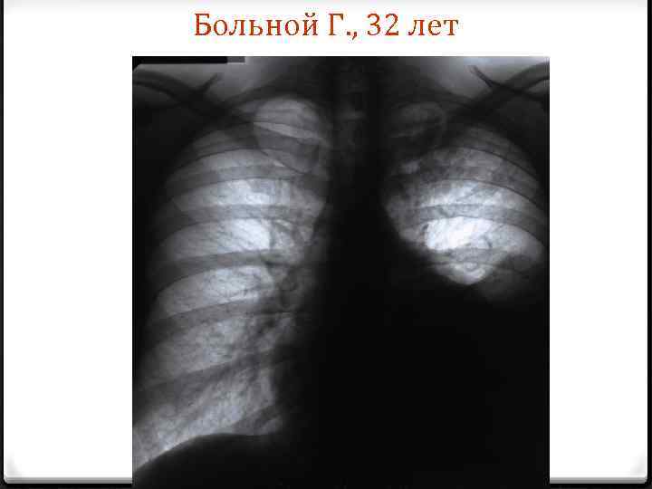 Больной Г. , 32 лет 