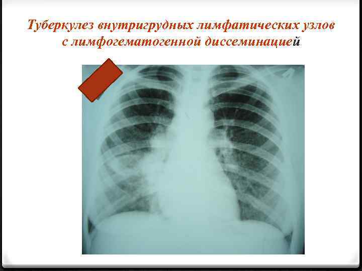 Туберкулез внутригрудных лимфатических узлов с лимфогематогенной диссеминацией 