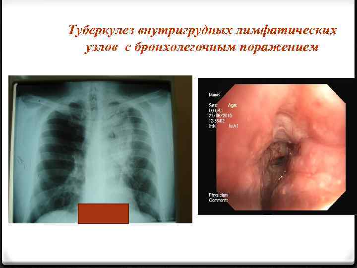 Туберкулез внутригрудных лимфатических узлов с бронхолегочным поражением 