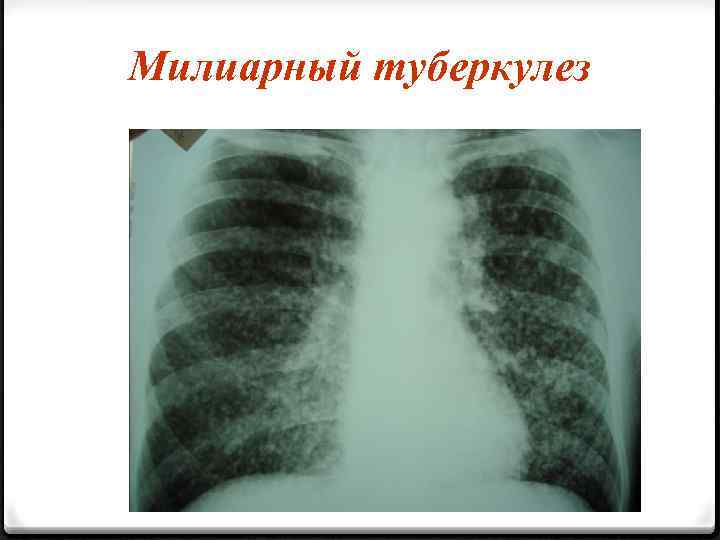 Милиарный туберкулез 
