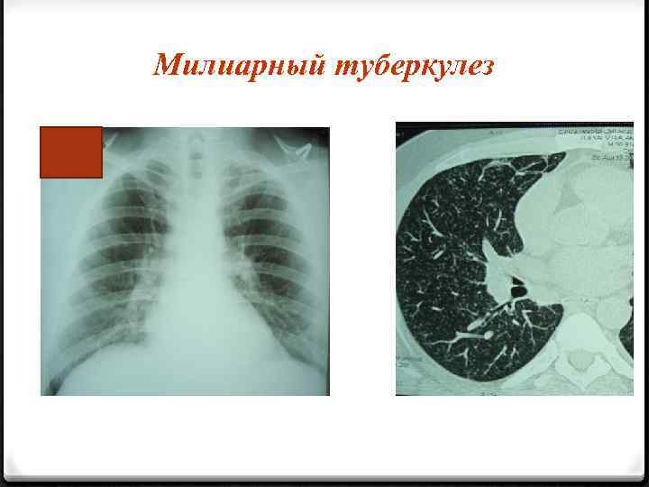 Милиарный туберкулез 