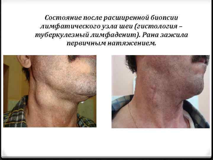 Состояние после расширенной биопсии лимфатического узла шеи (гистология – туберкулезный лимфаденит). Рана зажила первичным