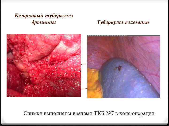 Бугорковый туберкулез брюшины Туберкулез селезенки Снимки выполнены врачами ТКБ № 7 в ходе операции
