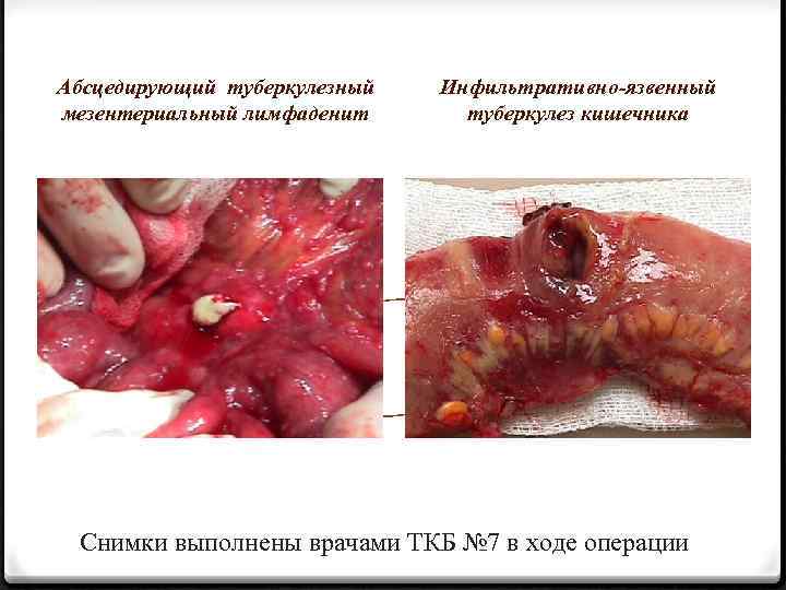 Абсцедирующий туберкулезный мезентериальный лимфаденит Инфильтративно-язвенный туберкулез кишечника Снимки выполнены врачами ТКБ № 7 в