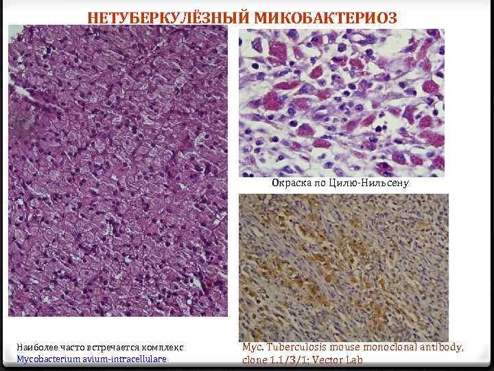 НЕТУБЕРКУЛЁЗНЫЙ МИКОБАКТЕРИОЗ Окраска по Цилю-Нильсену Наиболее часто встречается комплекс Mycobacterium avium-intracellulare Myc. Tuberculosis mouse