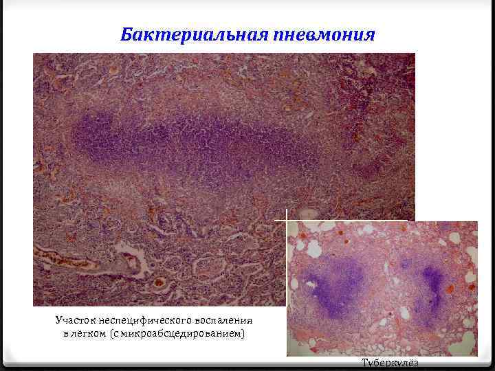 Бактериальная пневмония Участок неспецифического воспаления в лёгком (с микроабсцедированием) Туберкулёз 