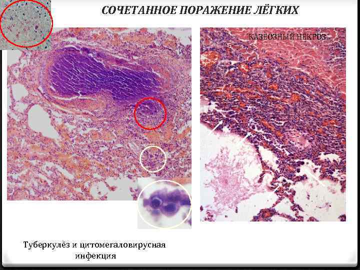 СОЧЕТАННОЕ ПОРАЖЕНИЕ ЛЁГКИХ КАЗЕОЗНЫЙ НЕКРОЗ Туберкулёз и цитомегаловирусная инфекция 