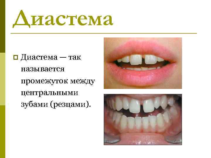 Какое расстояние между зубами. Диастема верхнего зубного ряда. Диастемы между передними зубами.