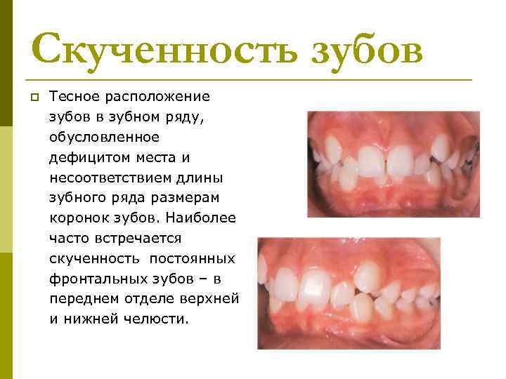 Скученность зубов p Тесное расположение зубов в зубном ряду, обусловленное дефицитом места и несоответствием