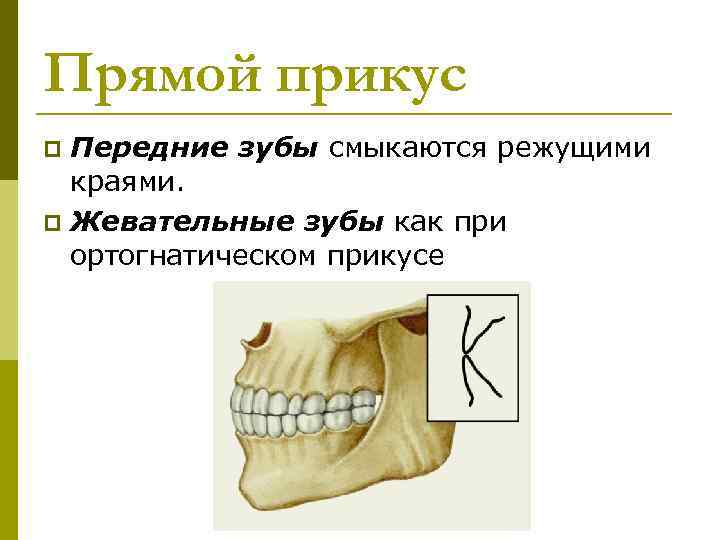 Прямой прикус Передние зубы смыкаются режущими краями. p Жевательные зубы как при ортогнатическом прикусе