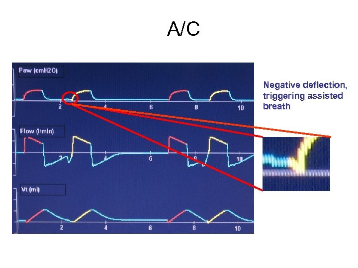 A/C Negative deflection, triggering assisted breath 