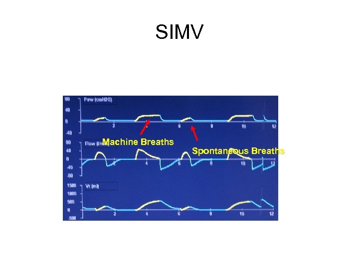 SIMV Machine Breaths Spontaneous Breaths 