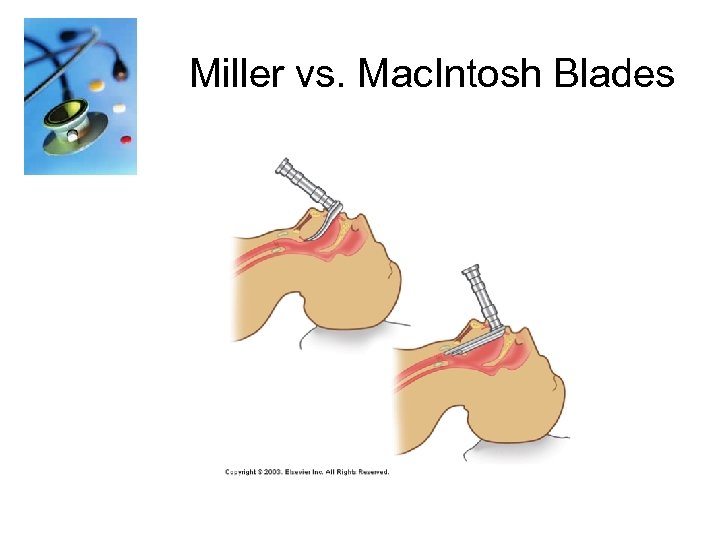 Miller vs. Mac. Intosh Blades 