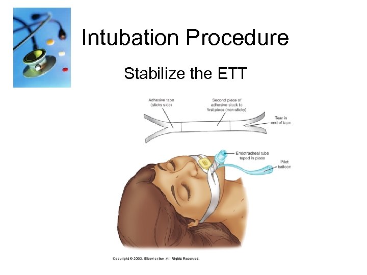 Intubation Procedure Stabilize the ETT 