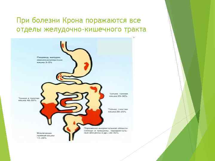 При болезни Крона поражаются все отделы желудочно-кишечного тракта 