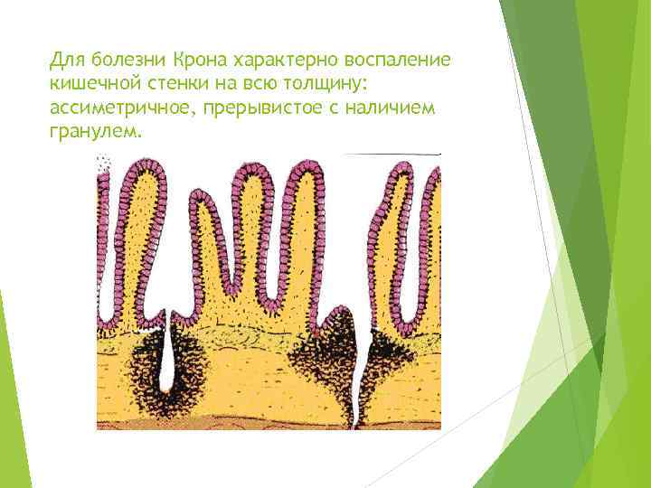 Для болезни Крона характерно воспаление кишечной стенки на всю толщину: ассиметричное, прерывистое с наличием