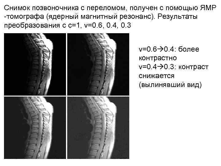 Снимок позвоночника с переломом, получен с помощью ЯМР -томографа (ядерный магнитный резонанс). Результаты преобразования