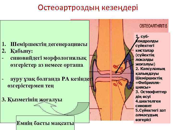 Остеоартроздың кезеңдері 1. суб- 1. Шеміршектің дегенерациясы 2. Қабыну: - синовийдегі морфологиялық өзгерістер аз