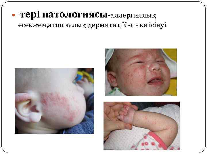  тері патологиясы-аллергиялық есекжем, атопиялық дерматит, Квинке ісінуі 