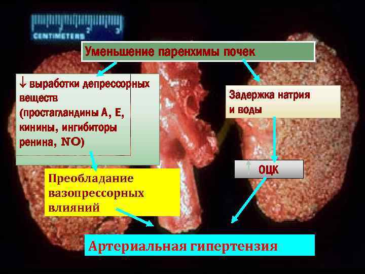 Уменьшение паренхимы почек выработки депрессорных веществ (простагландины А, Е, кинины, ингибиторы ренина, NO) Преобладание