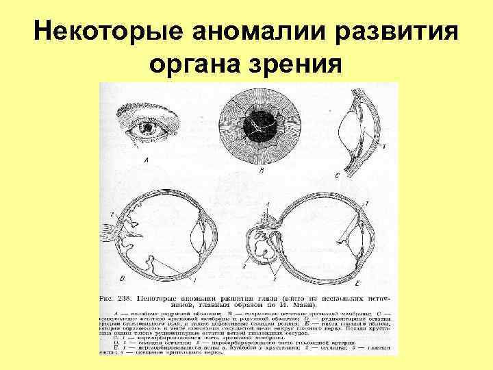 Некоторые аномалии развития органа зрения 