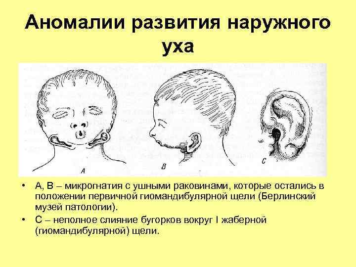 Аномалии развития уха презентация