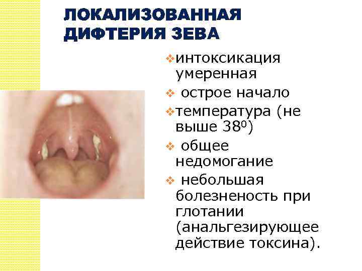 ЛОКАЛИЗОВАННАЯ ДИФТЕРИЯ ЗЕВА vинтоксикация умеренная v острое начало vтемпература (не выше 380) v общее