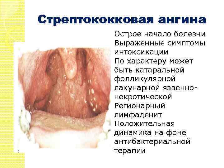 Стрептококковая ангина Острое начало болезни Выраженные симптомы интоксикации По характеру может быть катаральной фолликулярной